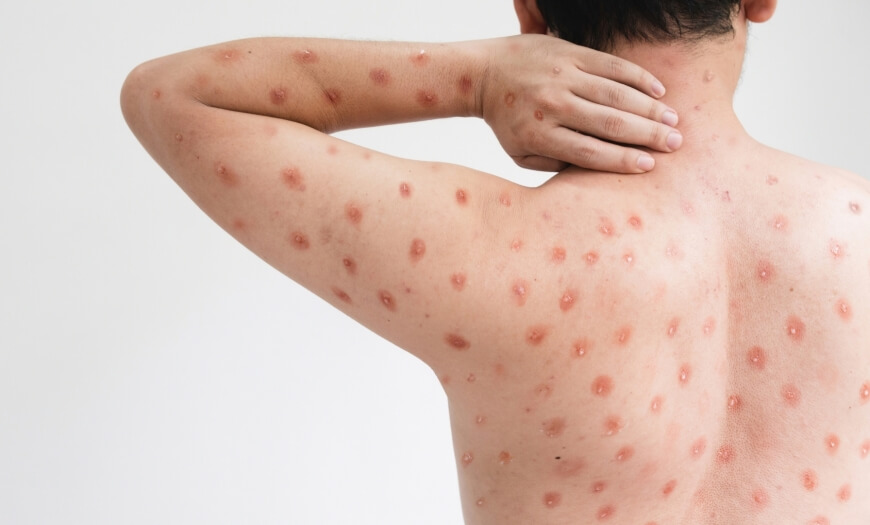 Aumento de casos de Mpox no Brasil: o que você precisa saber para se proteger