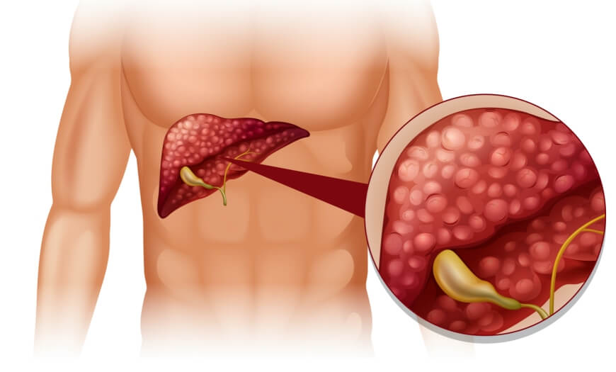 Quais os sintomas do câncer no pâncreas?